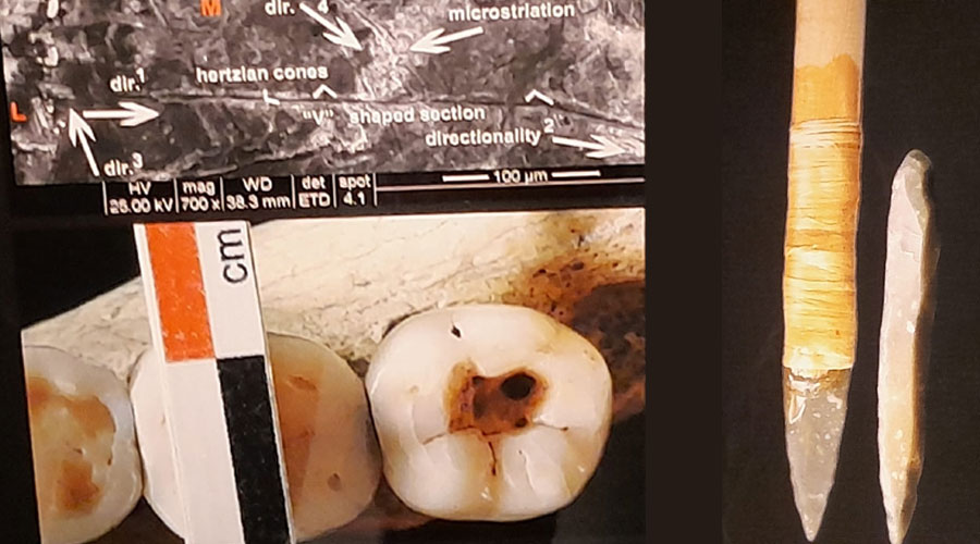 Clicca per accedere all'articolo L' odontoiatra di 14mila anni fa: la prima cura dentale all'Uomo di Villabruna nella Val Rosna